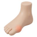 Foot with bunion at big toe